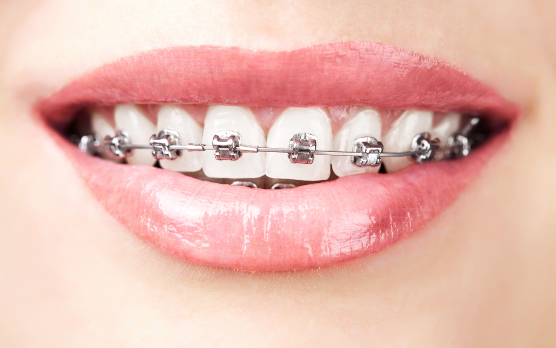 close up shot of braces
