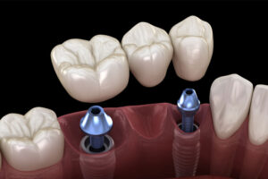 Affordable Dental Implants Charlotte NC