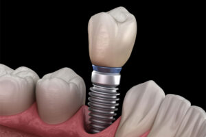 Dental Implants Charlotte NC