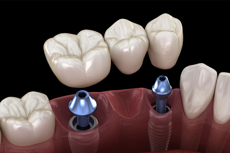 Teeth Extractions Charlotte NC