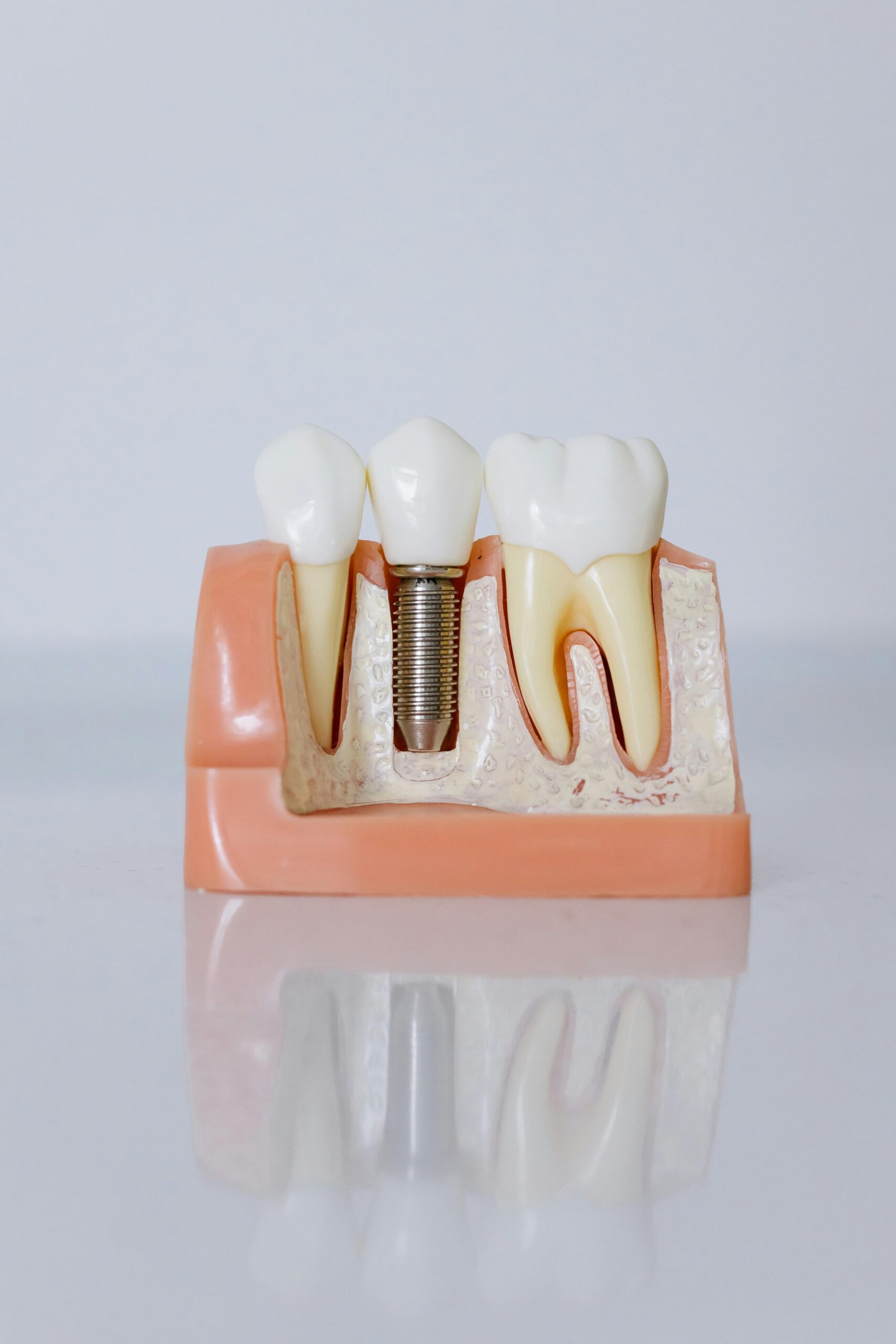 single tooth replacement charlotte nc