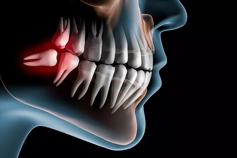 wisdom tooth extraction charlotte