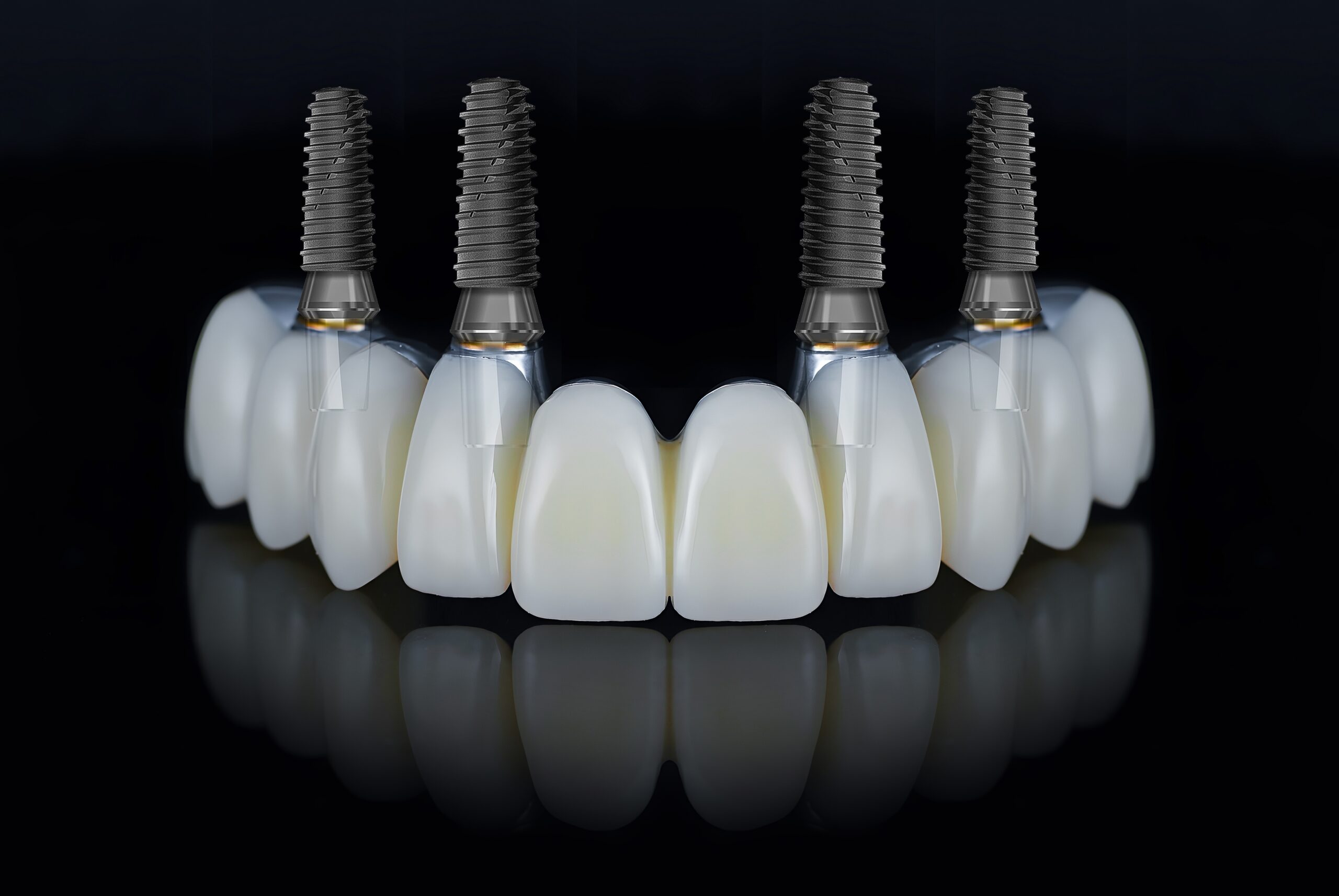 all on 4 dental implants