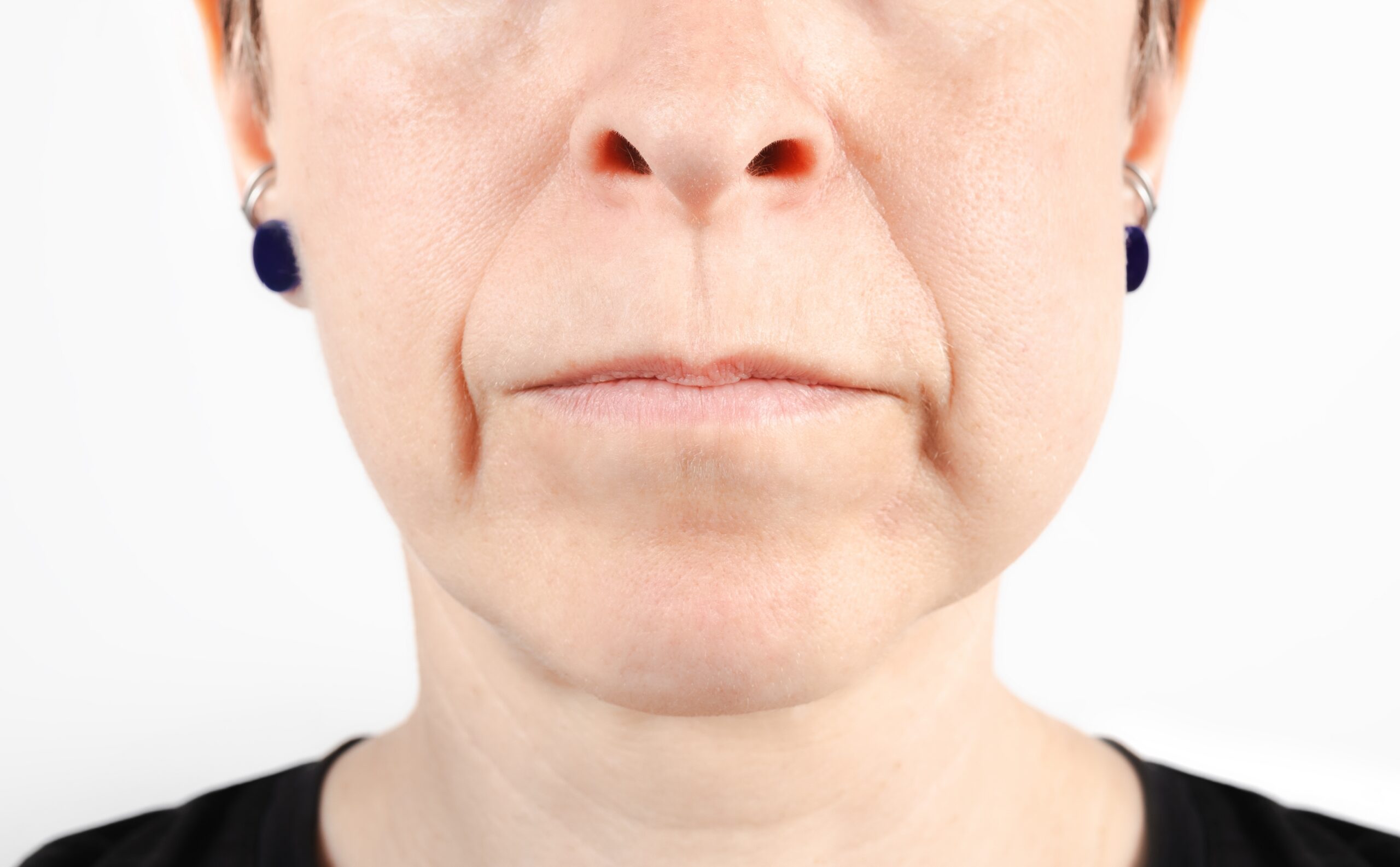 jaw surgery recovery
