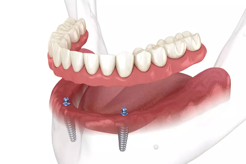 fixed implant dentures