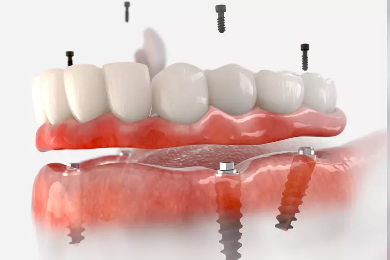 removable dental implants